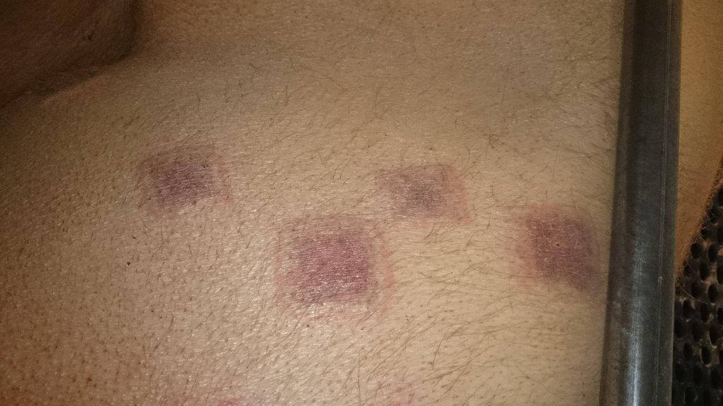 In 2013 zag Hans Welten ineens zeugen met hoge koorts (42 graden) in het kraamhok en met kleine vierkante vlekken op de huid.